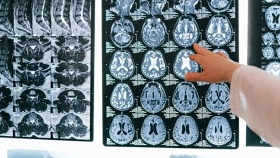 Identifying the Symptoms of Malignant Brain Tumors: What You Need to Know