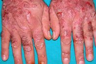 مرضى الصدفية