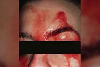 فتاة تتعرق دما فى الجبهة