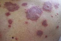 مرضى اللوكيميا