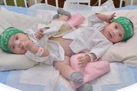 التوأم السيامي