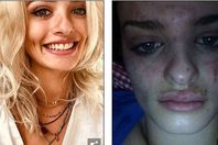 قبل وبعد الإصابة