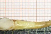 أطول سن بشري