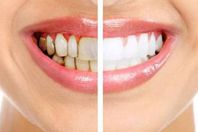 جير الاسنان