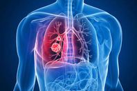 سرطان الرئة