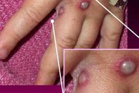 فيروس جدرى القردة