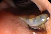 دودة تتشبث بكبد رجل مكسيكي