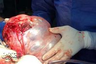 مؤشرات بتعافى فتاة الإسكندريه من الورم السرطانى 20 كيلو