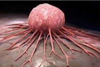 سرطان (أرشيفية)