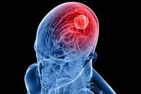 سرطان الدماغ