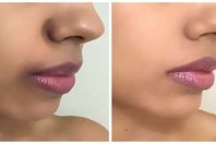 السواد حول الفم 

