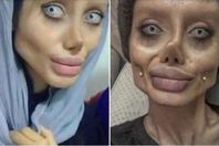 الفتاة التي شوهت وجهها لتبدو مثل "أنجلينا جولي"