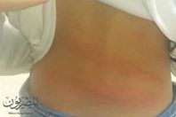 الطفلة  المصابة