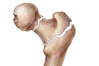 "دراسة": الإكزيما ترفع من خطر الإصابة بهشاشة العظام