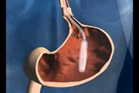 طبيب: عملية "تحويل مسار المعدة" الأمل بالشفاء من السكر