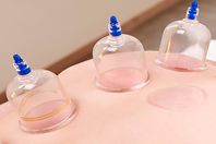 10 فوائد الحجامة