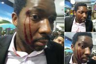 ممثل كاد أن يفقد إحدى عينيه بسبب العنصرية