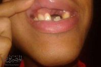 السجن 6 أشهر لمدير مدرسة حطم أسنان طالب ثانوي