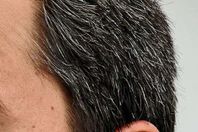 الشيب المبكر