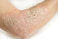 معلومات غريبة عن مرض الصدفية