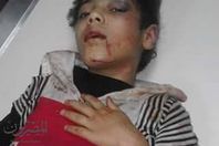 الطفلة المصابة