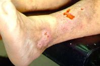 تقرحات مرض السكري (أرشيفية)