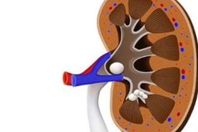 حصوات الكليتين