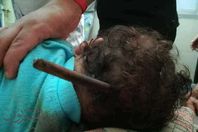 فريق طبي ينقذ طفل اخترق راسه سيخ حديدي بعد سقوطه  بالغربية