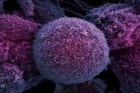 خلايا سرطانية