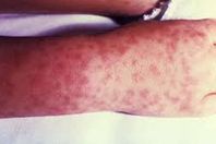 امتداد لكورونا.. وباء جديد يضرب دولة عربية