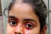 حالة نادرة.. طفلة تبكي دمًا بدلاً من الدموع
