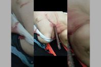 العمر لحظة.. نجاة طفل سقط على سيخ حديدي طوله متر