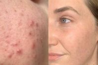 علاج «معجزة» للتخلص نهائيًا من حب الشباب