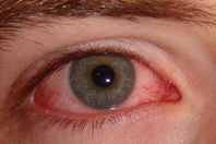 تعرف على "ذبابة العين الطائرة"