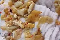 استئصال حصوات على شكل "بقايا طعام" بمستشفى المحلة العام