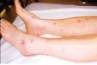 فيروس الضنك ارشيفية