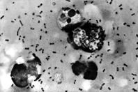 اكتشاف مرض جنسي خطير مقاوم للمضادات الحيوية