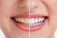 تبييض الأسنان