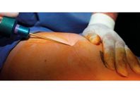 كيف_تتم_عملية_شفط_الدهون