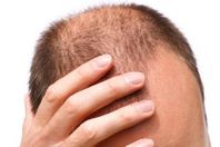 دراسة.. مرض "الصلع" سببه الأم