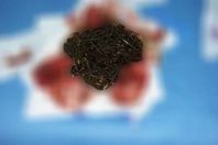 مسامير من بطن المريض