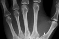 تظهر صورة التُقِطت بالأشعة السينية لليد اليسرى للدكتور مارك غاسون