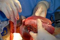 تجارة الاعضاء