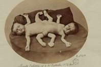 أول توأم ملتصق في مصر 