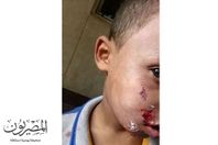 كلب يعقر 16 طفلا من 4 مناطق بطنطا