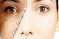 البقع البنية في الوجه