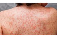 مرض مجهول ينهي حياة العشرات بدولة عربية
