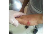 قليل البخت.. أول من شفي من الإيدز يصاب هذا المرض
