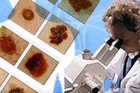 سرطان "القولون" الأكثر انتشار بين رجال الكويت وسرطان الثدي للنساء