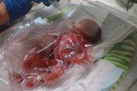 بالصور.. أغرب طريقة لإنقاذ رضيع ولد في بداية الشهر السادس